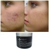 Natural Clear-Acne Treatment Mask-Works Better Than Benzoyl Peroxide