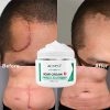 Scar Removal Cream, Advanced Acne Marks Treatment, Face and Body Skin
