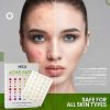 Acne Patches for Face - Hydrocolloid Bandages (540 Count) Pimple Patch