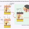 Natural Clear-Acne Treatment Mask-Works Better Than Benzoyl Peroxide