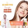 Ebanel Acne Drying Lotion, Overnight Salicylic Acid and Sulfur Cystic Acne